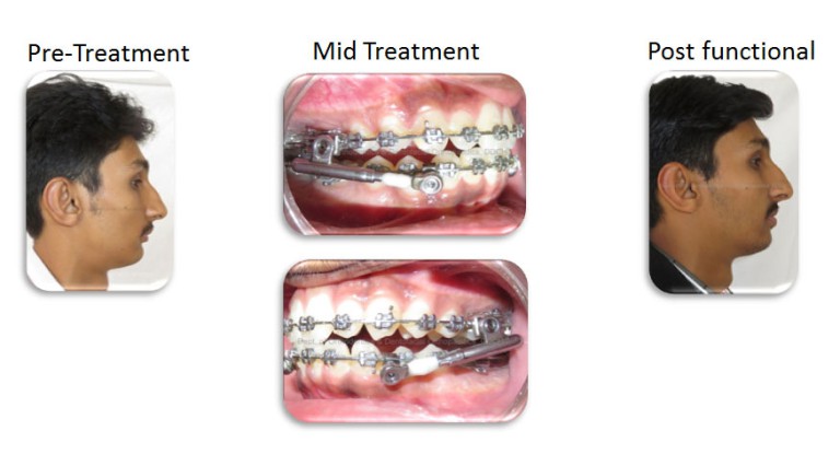 Treatment Gallery Orthodontics And Dentofacial Orthopedics - Darshan ...