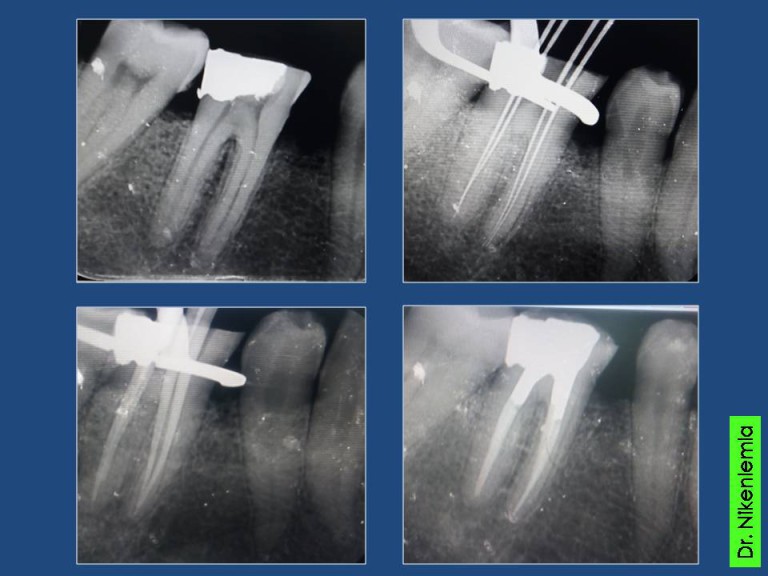 Treatment Gallery Conservative Dentistry and Endodontics Darshan