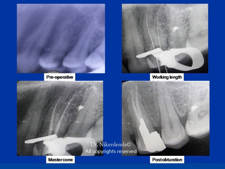 Treatment Gallery Conservative Dentistry and Endodontics Darshan